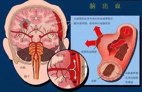 脑出血有什么特点 脑出血有哪些特别的表现
