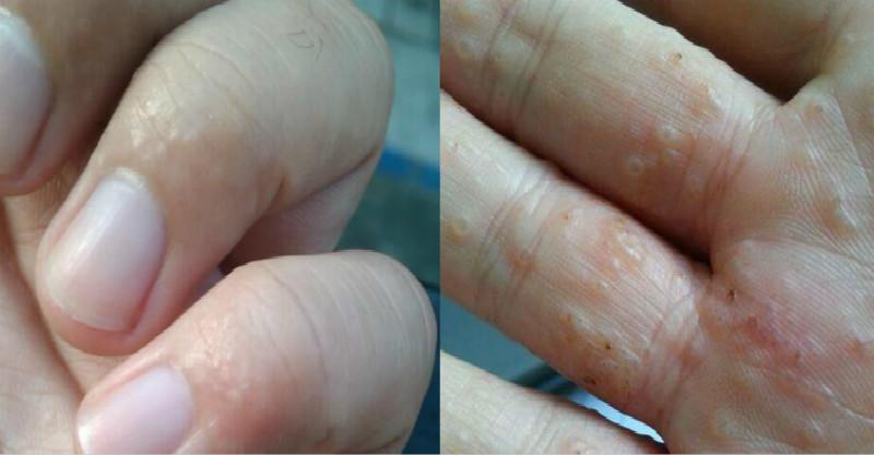 手上亮晶晶的小水疱,又痒又痛,反复发作,其实是汗疱疹在作怪!医生建议“这样”治疗..._来书生活健康百科 Laishu.com